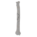 Radius - Canine - Fracture 22-C acc. to AOVet