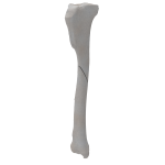 Tibia - Canine - Fracture 42-A2  acc. to AOVet