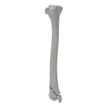 Tibia - Canine - Fracture 43-C2 acc. to AOVet