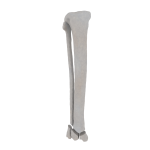 Tibia and Fibula - Feline - Fracture 43-C1 acc. to AOVet