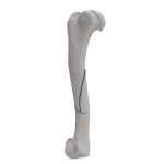 Humerus - Canine - Fracture 12-B1 acc. to AOVet