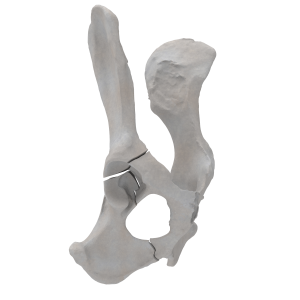 Pelvis - Canine - Acetabular Fracture (T-shape)
