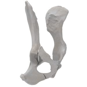 Pelvis - Canine - Oblique fracture through the cranial part of the body of the ilium and acetabulum