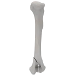 Humerus - Canine - Fracture 13-B2 acc. to AOVet