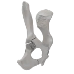 Pelvis - Canine - Acetabular Fracture (T-shape)