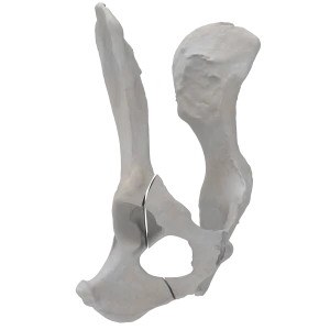 Pelvis - Canine - Oblique fracture through the cranial part of the body of the ilium and acetabulum