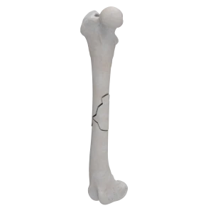 Femur - Canine - Fracture I 32-B1 acc. to AOVet