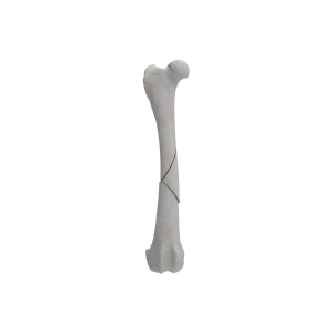 Femur - Canine - Fracture II 32-B1 acc. to AOVet
