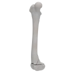 Femur - Canine - Fracture 33-A3 acc. to AOVet