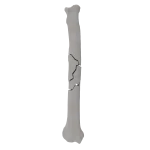 Radius - Canine - Fracture 22-C acc. to AOVet