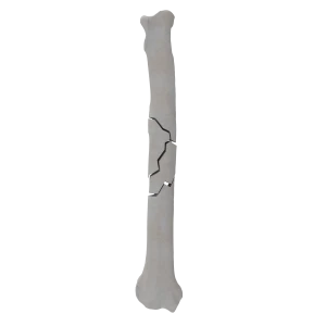 Radius - Canine - Fracture 22-C acc. to AOVet