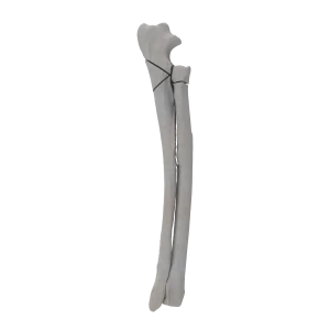 Radius and Ulna - Canine - Fracture 21-A3 acc. to AOVet