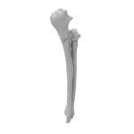 Radius and Ulna - Canine - Fracture 21-B3 acc. to AOVet