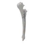 Radius and Ulna - Canine - Fracture 22-A3 acc. to AOVet