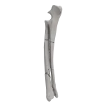 Radius and Ulna - Canine - Fracture 22-C2 acc. to AOVet