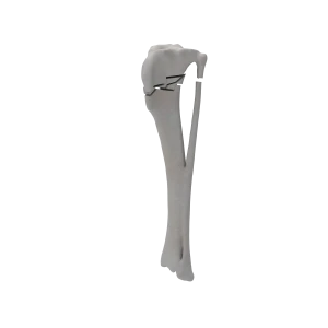 Tibia and Fibula - Canine - Fracture 41-A3 acc. to AOVet