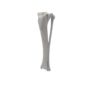 Tibia and Fibula - Canine - Fracture 41-B1 acc. to AOVet
