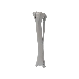 Tibia and Fibula - Canine - Fracture 41-B2 acc. to AOVet