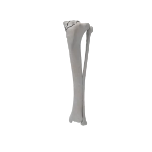 Tibia and Fibula - Canine - Fracture 41-B3 acc. to AOVet