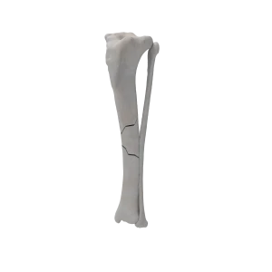 Tibia and Fibula - Canine -  Fracture 42-A1 acc. to AOVet