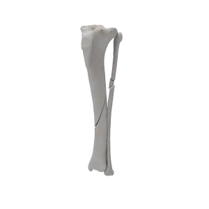 Tibia and Fibula - Canine - Fracture 42-A2 acc. to AOVet