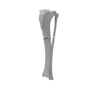 Tibia and Fibula - Canine - Fracture 42-A3 acc. to AOVet