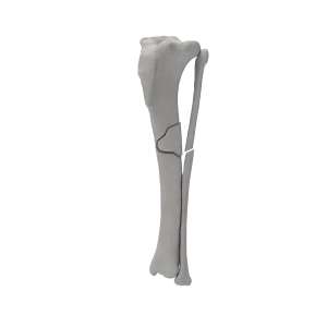 Tibia and Fibula - Canine - Fracture 42-B1 acc. to AOVet