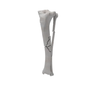 Tibia and Fibula - Canine - Fracture 42-B2 acc. to AOVet