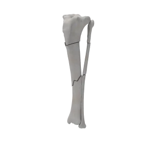 Tibia and Fibula - Canine - Fracture 42-C2 acc. to AOVet