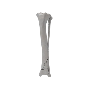 Tibia and Fibula - Canine - Fracture 43-A2 acc. to AOVet
