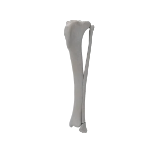 Tibia and Fibula - Canine - Fracture 43-B1 acc. to AOVet