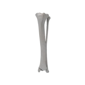 Tibia and Fibula - Canine - Fracture 43-B2 acc. to AOVet
