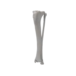 Tibia and Fibula - Canine - Fracture 43-B3 acc. to AOVet