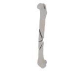 Femur - Feline - Fracture 32-B2 acc. to AOVet