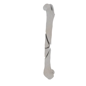 Femur - Feline - Fracture 32-B2 acc. to AOVet