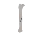Femur - Feline - Fracture 32-A2 acc. to AOVet