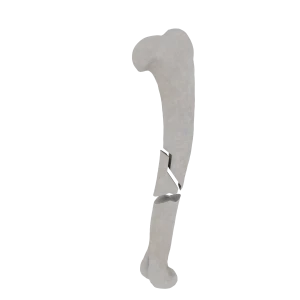 Humerus - Feline - Fracture 12-B1 acc. to AOVet