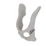 Pelvis - Feline - Oblique fracture through the caudal part of the body of the ischium and acetabulum