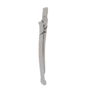 Radius and Ulna - Feline - Fracture 21-A3 acc. to AOVet
