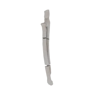 Radius and Ulna - Feline - Fracture 22-C2 acc. to AOVet