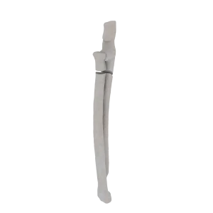 Radius and Ulna - Feline - Fracture 22-A3 acc. to AOVet