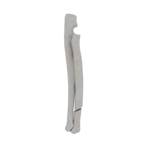 Radius and Ulna - Feline - Fracture 22-A1-Radial acc. to AOVet 