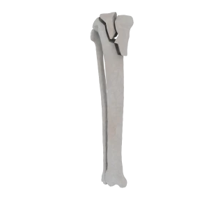 Tibia and Fibula - Feline - Fracture 41-B3 acc. to AOVet