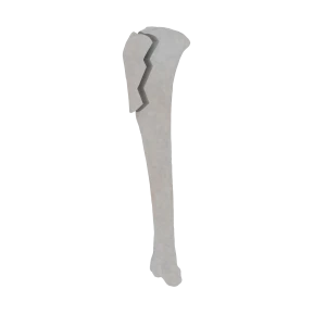 Tibia and Fibula - Feline - Fracture 41-A1 acc. to AOVet 