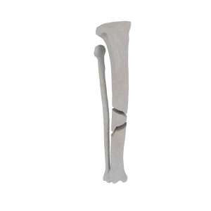 Tibia and Fibula - Feline - Fracture 42-A1 acc. to AOVet