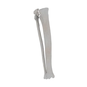 Tibia and Fibula - Feline - Fracture 41-B1 acc. to AOVet