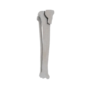 Tibia and Fibula - Feline - Fracture 41-B2 acc. to AOVet 