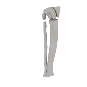 Tibia and Fibula - Feline - Fracture 41-C1 acc. to AOVet 