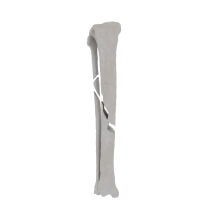 Tibia and Fibula - Feline - Fracture 42-A2 acc. to AOVet