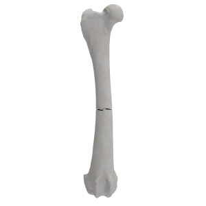 Femur - Canine - Fracture 32-A3 acc. to AOVet